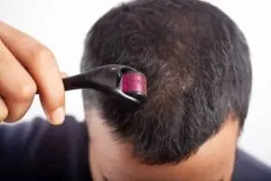 Does Using a Dermaroller For Hair Growth Work? using a dermaroller for hair growth