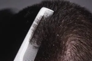 Does Dandruff Cause Hair Loss? what is dandruff