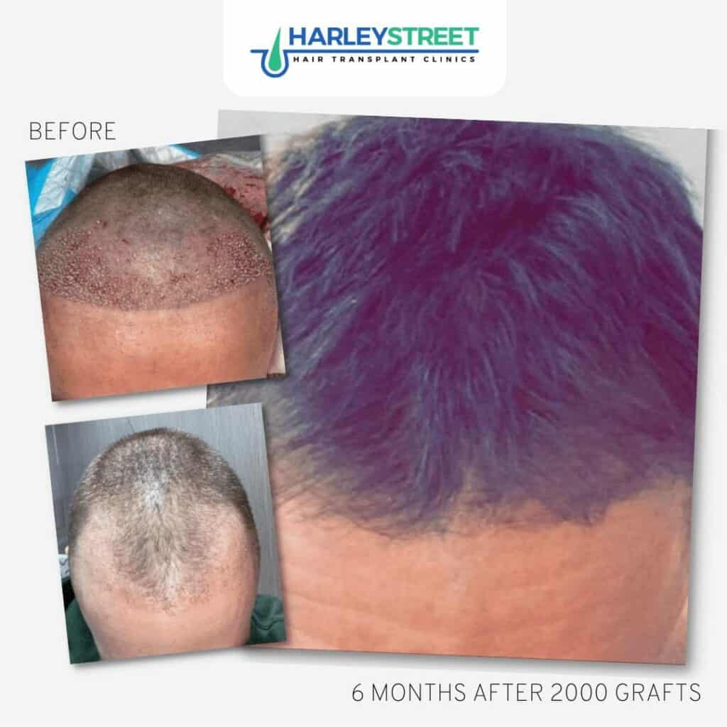 Hair Transplant Before and After 10 FUE-Before-and-After-9