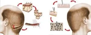 Hair Transplants 1 hair-transplant-procedures-300x116