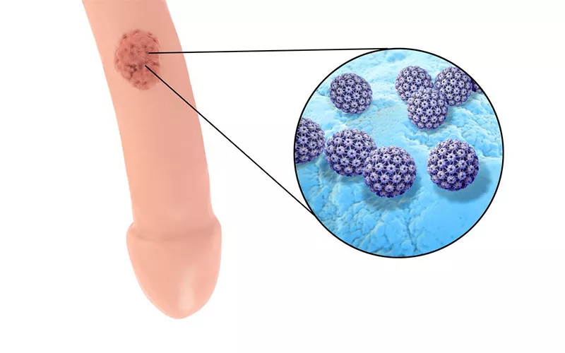 Τι πρέπει να γνωρίζετε για τα κονδυλώματα 2 Diagnosi HPV