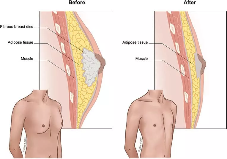 Γυναικομαστία 3 Gynecomastia