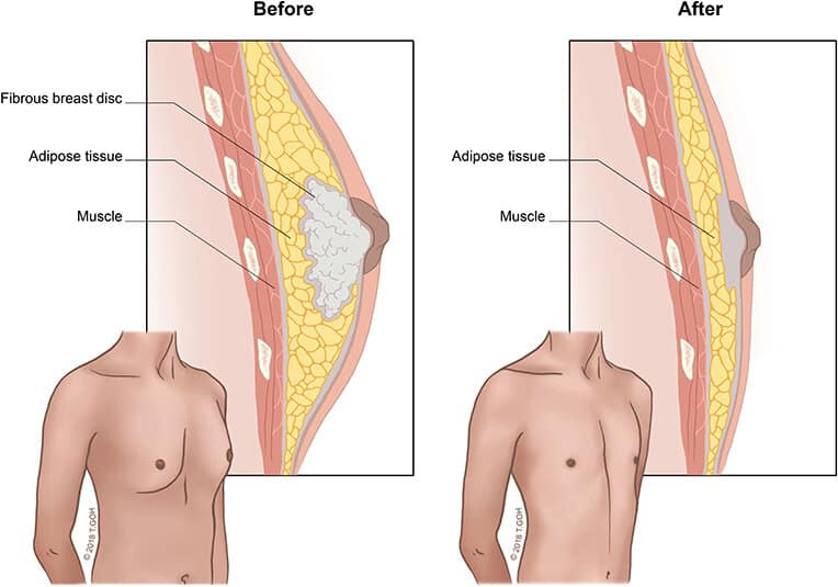 Gynecomastia