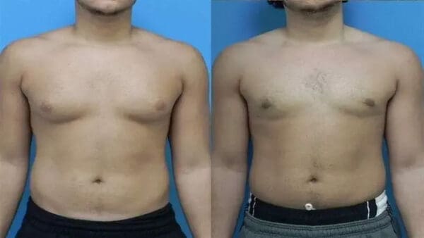 Gynectrol Κριτική 3 before and after photos 1