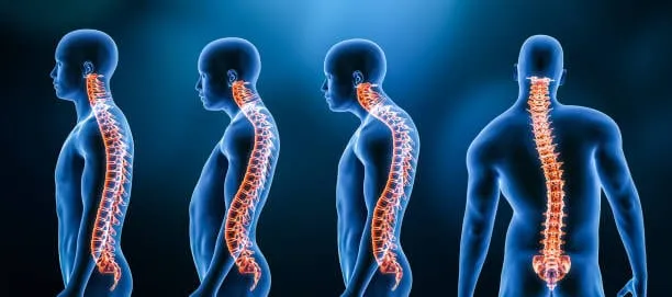 Σκολίωση ασκήσεις 1 scoliosis