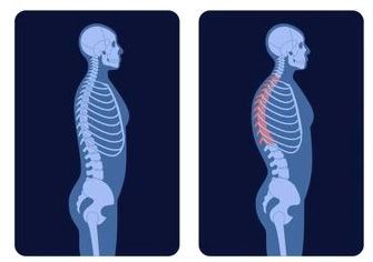 kyphosis man 1