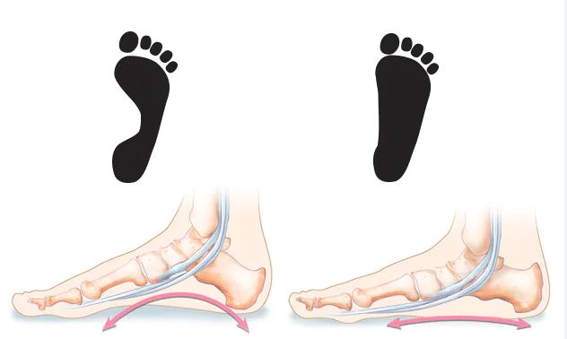 flatfeet