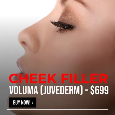 CHEEK FILLER - VOLUMA (JUVEDERM)