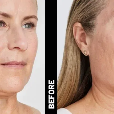 ULTHERAPY Non-Surgical FACE-LIFT - Full Face or Full Neck Ultherapy