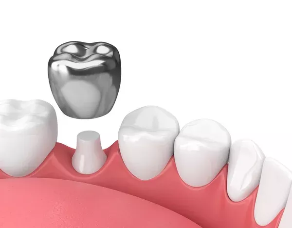 Dental Crown Without Root Canal: When It’s Possible and What to Know
