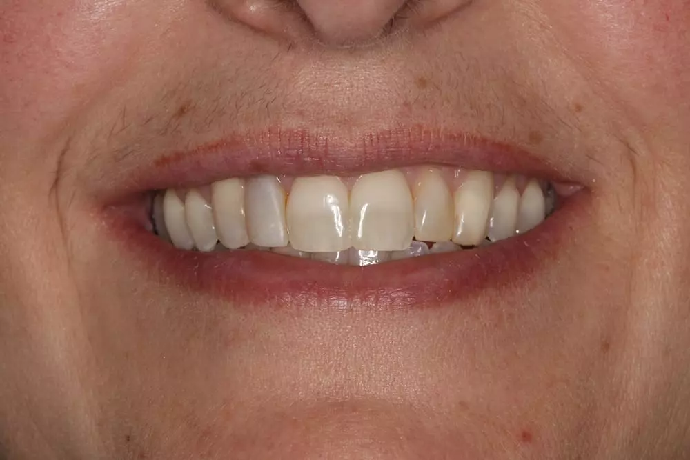 AddVeneers1b