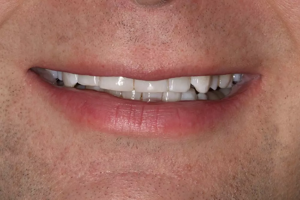 AddVeneers2b