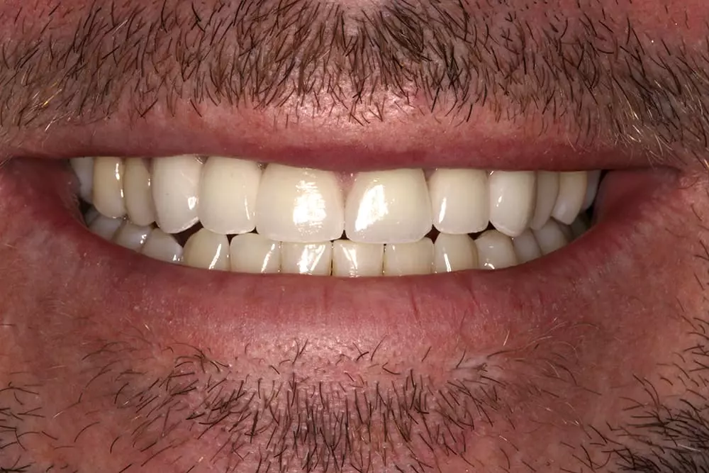 BridgeVeneers1a