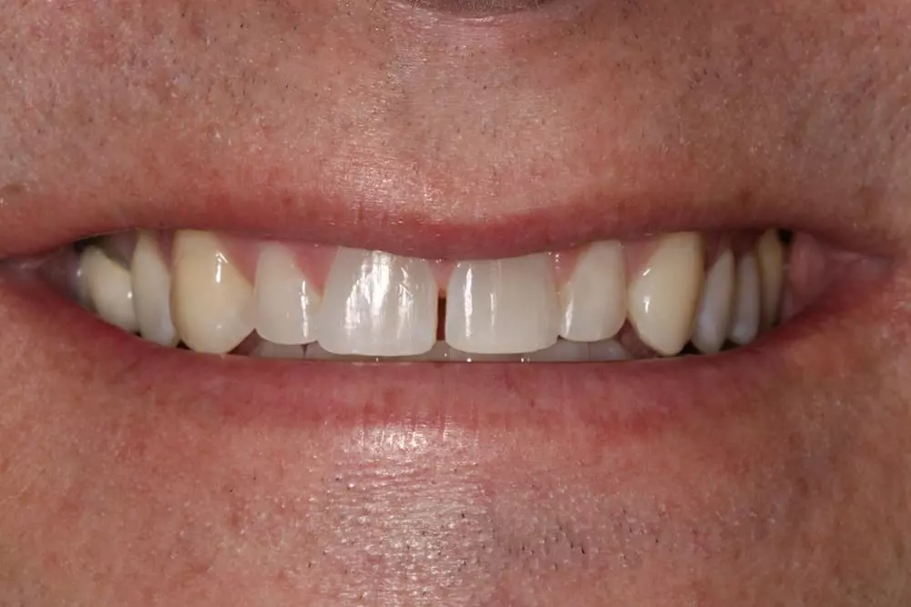 Veneers3b