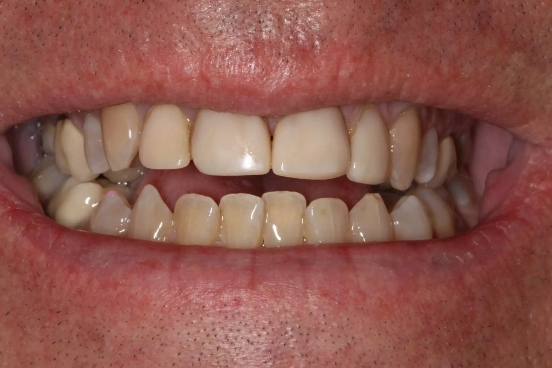 Veneers4b-min