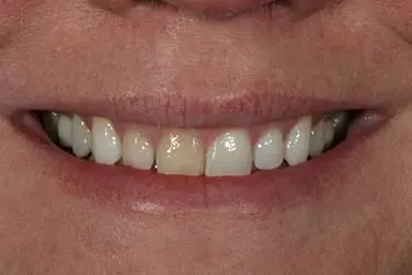 Whtening-Before-After